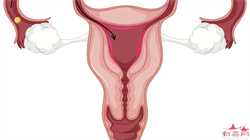 子宫内膜息肉手术做完多长时间可以做试管